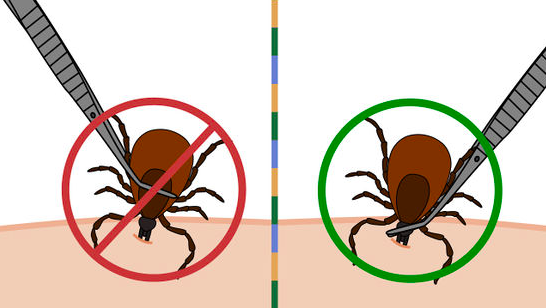 Illustration showing the wrong and the right way of removing ticks from the body