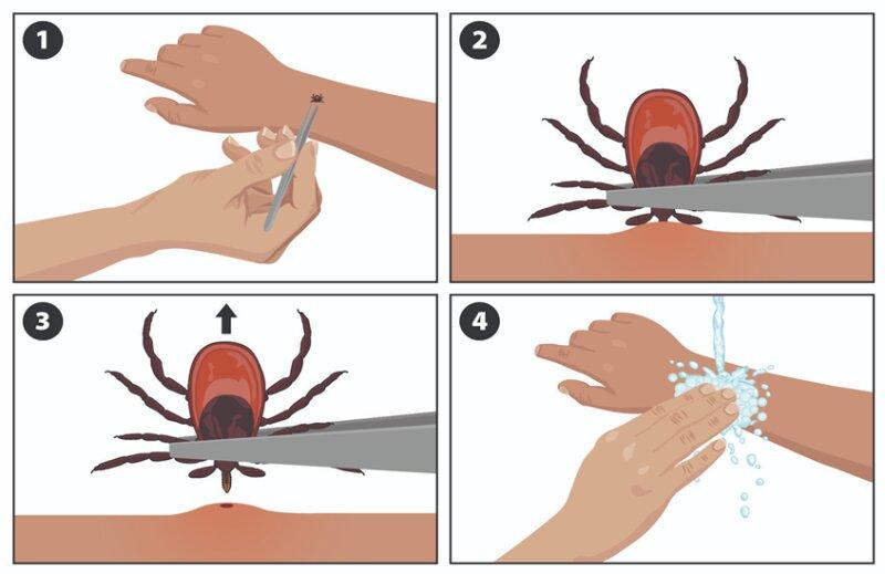 Tick Removal Tips